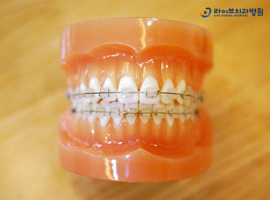 세라믹교정, 경제적인 교정치료의 대명사 관련 이미지 3