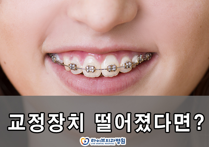 교정장치 떨어짐 어떻게 해야하죠? 관련 이미지 1