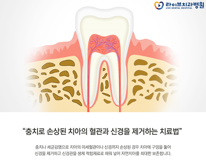 치아 신경치료 과정 궁금하시죠? 관련 이미지 2