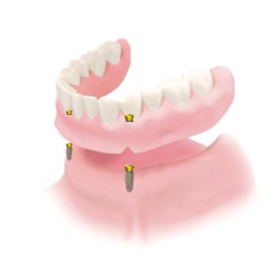 임플란트틀니, 보다 만족도를 높이려면? 관련 이미지 2