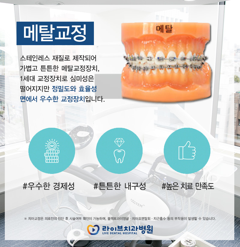 치아교정기종류 어디까지 알고있니 관련 이미지 2