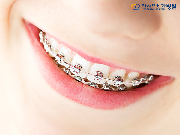 치아교정비용, 합리적인 선택의 기준은? 관련 이미지 3