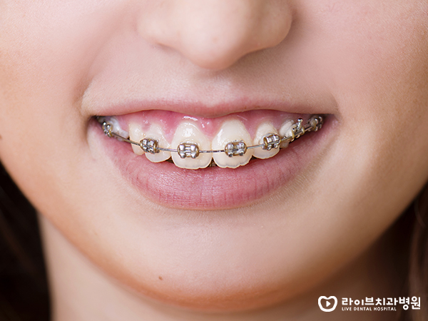투명교정, 티나지 않게 미소에 자신감을! 관련 이미지 2