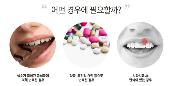 치아미백치료, 변색된 치아를 환하게! 관련 이미지 4