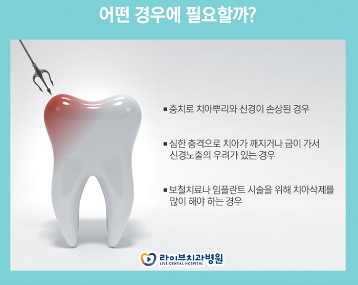 치아 신경치료 과정 궁금하시죠? 관련 이미지 3