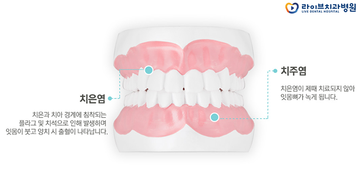 잇몸치료 방법 치료과정에 대해서 관련 이미지 4