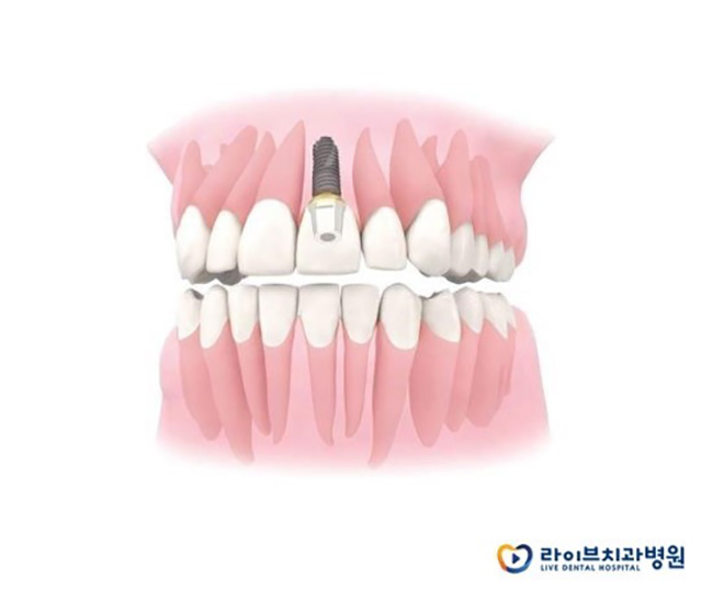 임플란트비용을 선택기준으로 생각하는 당신께 관련 이미지 2