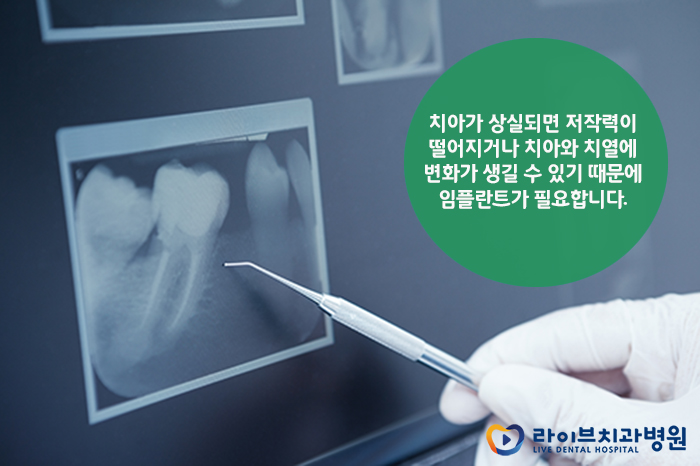 임플란트가격 잘 따져보고 선택하자 관련 이미지 3