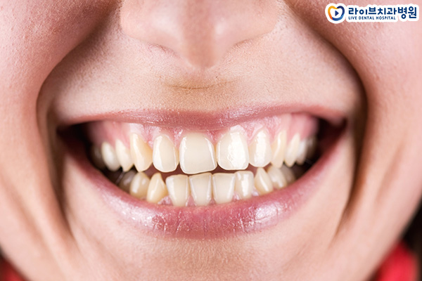 아랫니교정 받을 수 있을까요? 관련 이미지 2