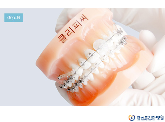 라이브하게 알아보는 교정용 왁스 사용법 관련 이미지 6