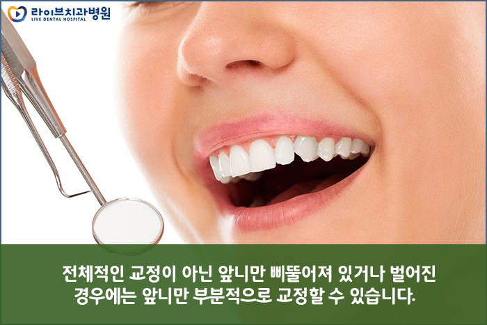 앞니부분교정, 부담없이 원하는 부위만 확실하게 관련 이미지 3