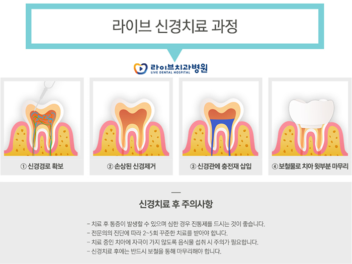 치아 신경치료 과정 궁금하시죠? 관련 이미지 4