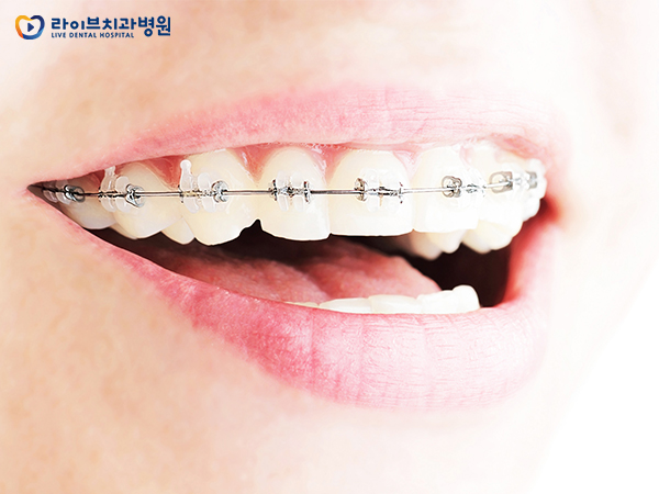 치아교정시기, 지금 시작하면 늦지 않을까? 관련 이미지 3