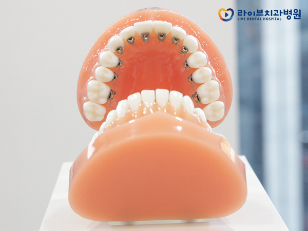 설측교정 무엇을 알아봐야할까? 관련 이미지 3