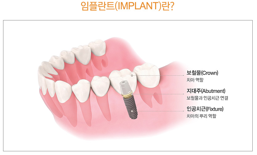 임플란트잘하는곳 사후관리까지 관련 이미지 2