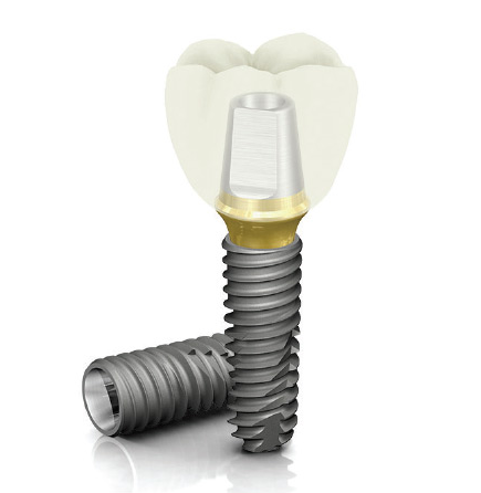 임플란트 가격과 함께 알아볼 체크사항 관련 이미지 12