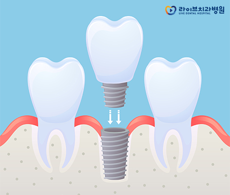 임플란트비용, 그보다 더 중요한 것은? 관련 이미지 2