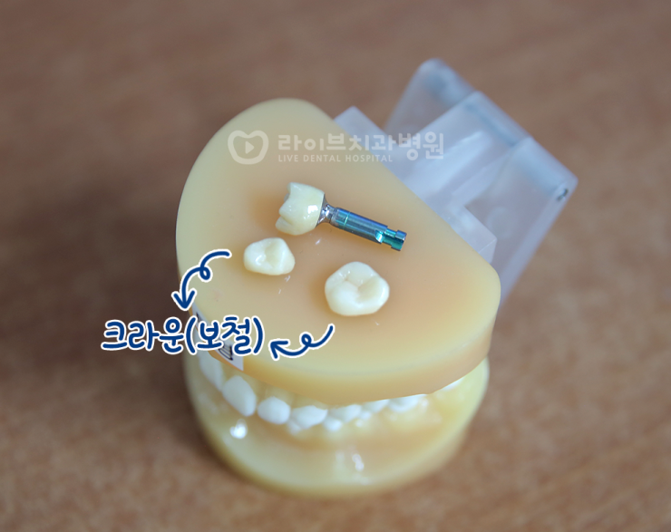 [11월세미나] 강남점 치과위생사 세미나 - 전악보철 9강 관련 이미지 2