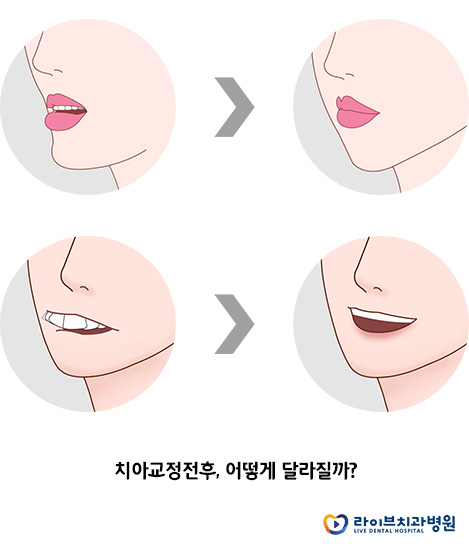 치아교정전후, 달라질 모습을 기대해도 될까요? 관련 이미지 3