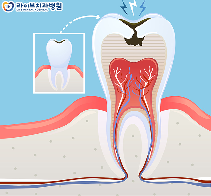 충치 자가진단법 확인해봐요 관련 이미지 2