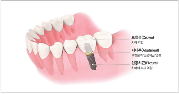 임플란트 가격과 함께 알아볼 체크사항 관련 이미지 5