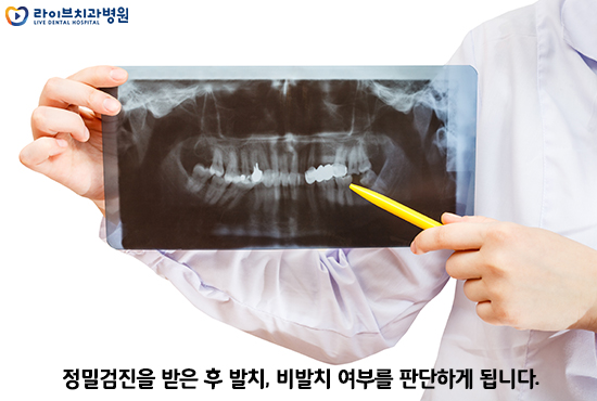 발치교정, 비발치교정이 결정되는 요인은? 관련 이미지 3