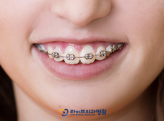치아교정비용, 저렴하면 무조건 오케이? 관련 이미지 3