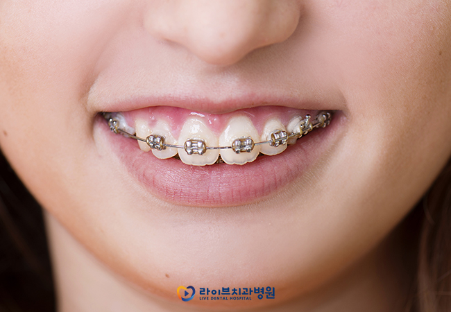 치아교정비용, 장치와 방법에 따라 달라질 수 있다? 관련 이미지 2