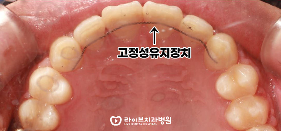 강남점 스텝세미나 - 픽스드 & 디본딩 과정 관련 이미지 6