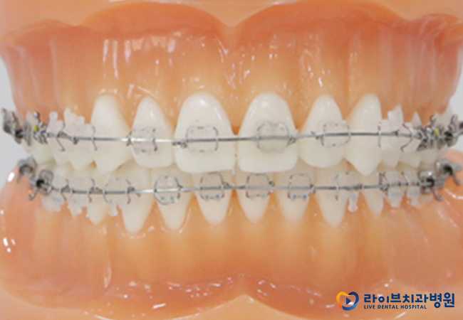 세라믹교정, 어떤 장점들이 있을까요? 관련 이미지 4