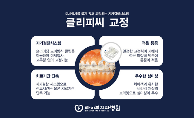 치아교정기 종류 올바르게 알아보자 관련 이미지 4