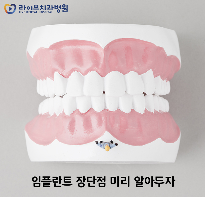 임플란트 장단점 차이가 궁금하다면! 관련 이미지 2