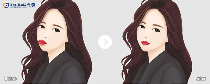 돌출입교정, 돌출입과의 이별을 선언하다 관련 이미지 4