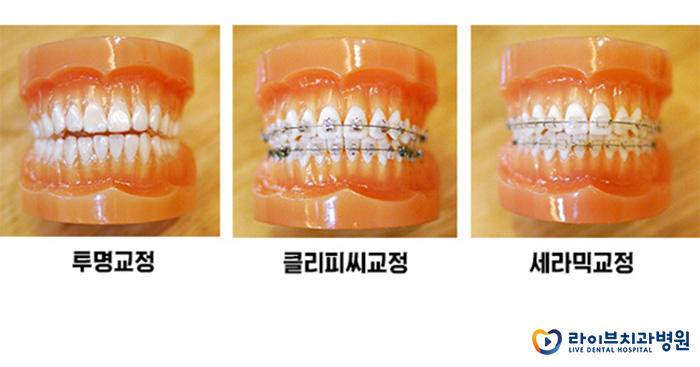 앞니부분교정, 어떤 케이스에 적합할까? 관련 이미지 4