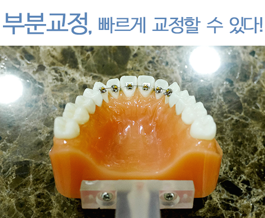 부분교정, 빠른 교정을 할 수 있다? 관련 이미지 5