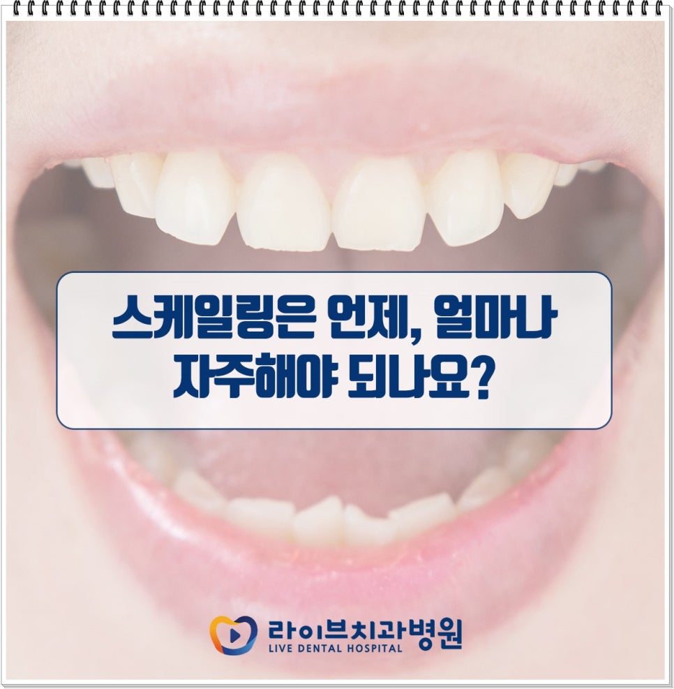 치석제거를 위한 스케일링 궁금증 풀어봐요 관련 이미지 5