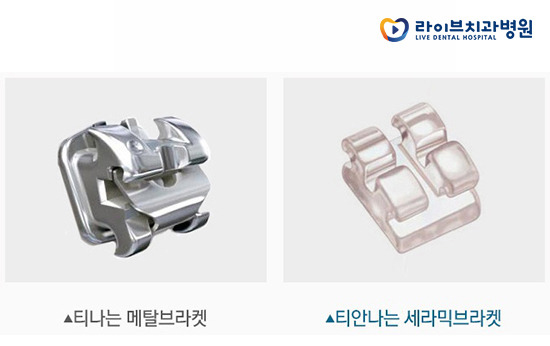 세라믹교정, 치아교정 잘하는 곳에서 받자! 관련 이미지 3