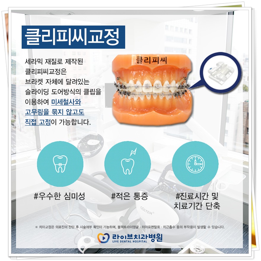 치아교정기 종류 원하는 목적에 맞게 관련 이미지 4