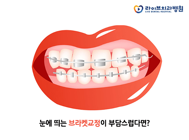 투명교정비용, 비용만 따진다고 될까? 관련 이미지 2