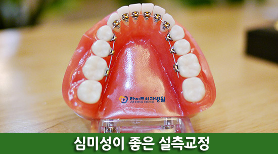 돌출입교정비용 부담없이 개선해보자! 관련 이미지 5