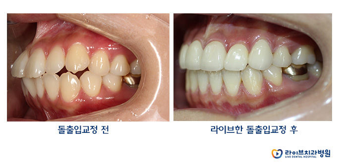 돌출입치아교정 잘하는 강남역치과 관련 이미지 3