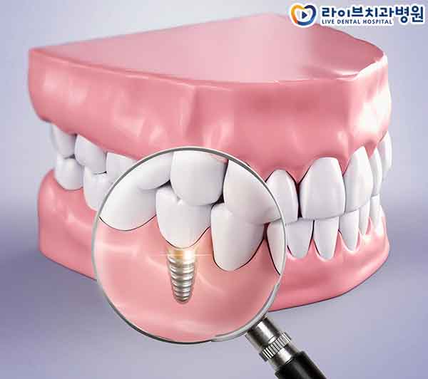 강남임플란트 어떻게 선택해야 할까요 관련 이미지 4