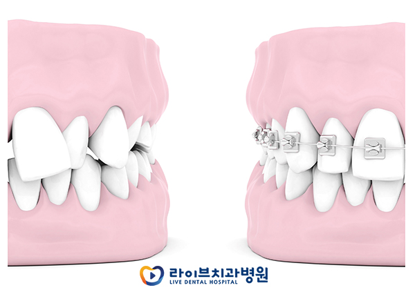 치아교정비용 걱정없이 시작하자 관련 이미지 2