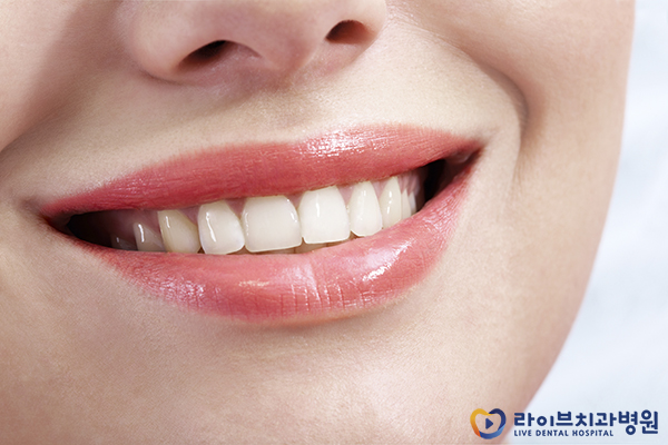 앞니부분교정 짧은 치료기간으로 치료받자 관련 이미지 2