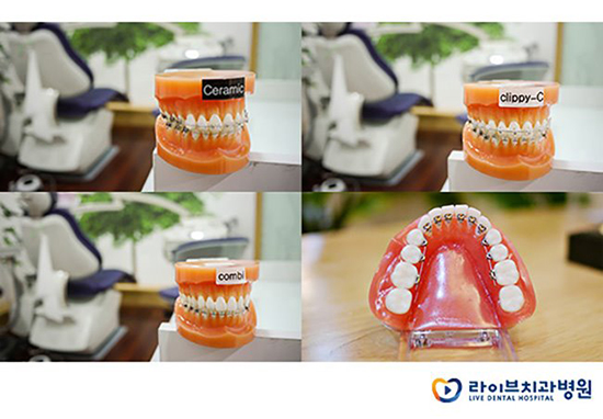 덧니교정 알아보고 계신가요? 관련 이미지 5