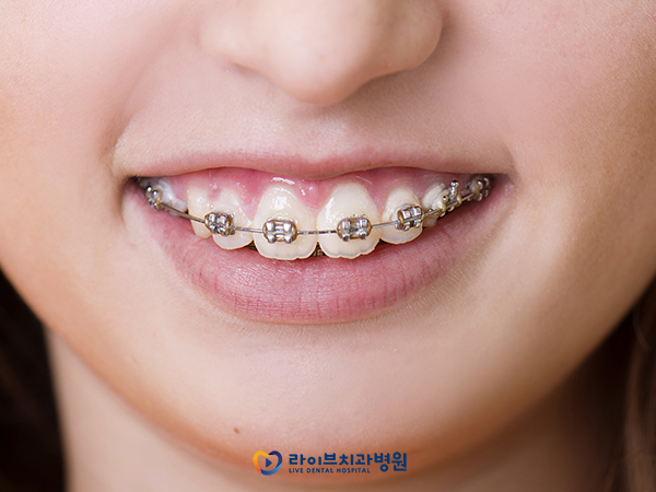 성인치아교정, 어떻게 알아보고 계세요? 관련 이미지 2