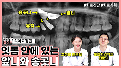 매복치를 동반한 부정교합 치료방법| 덴탈메이트 4탄 치아교정편 관련 이미지 1