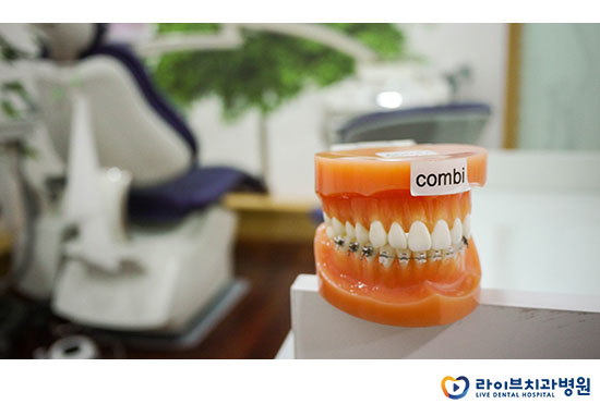 치아교정방법, 나에게 맞는 방법은 무엇일까? 관련 이미지 6