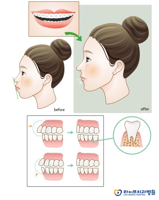돌출입교정, 입툭튀를 벗어나는 방법 관련 이미지 2