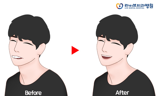 돌출입교정, 콤플렉스를 해소하는 방법 관련 이미지 3